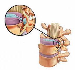 paramedian levy herniation l5 s1 