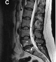 Herniated disc L5 S1: mahdolliset komplikaatiot ja hoitomuodot