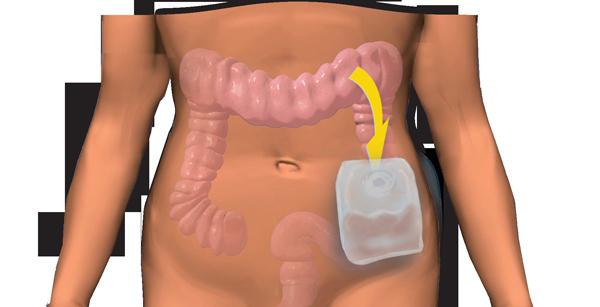 Kolostoma - mitä se on? Kolostomia: postoperatiivinen hoito