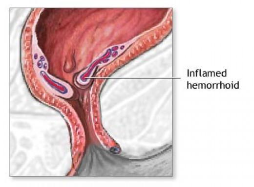 Voiteluaineet hemorrhoideille raskauden aikana