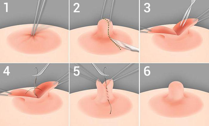  professori blohin plastiikkakirurgi