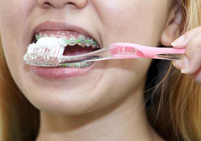 Levyt hampaiden kohdistamiseen: hammaslääkäreiden ja potilaiden arvioinnit