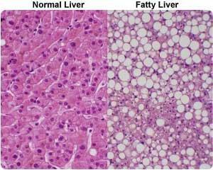 steatohepatosis -hoito