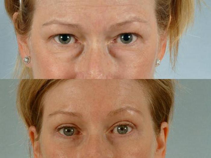 Transconjunctival blefaroplasty: kuvaus, indikaatiot, komplikaatiot ja vasteet